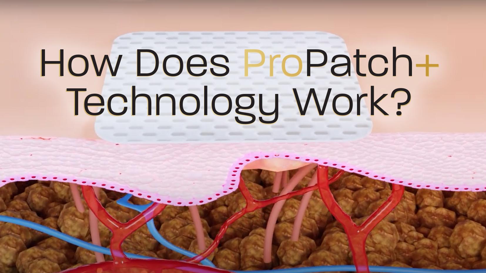 ProPatch Technology Video Thumbnail